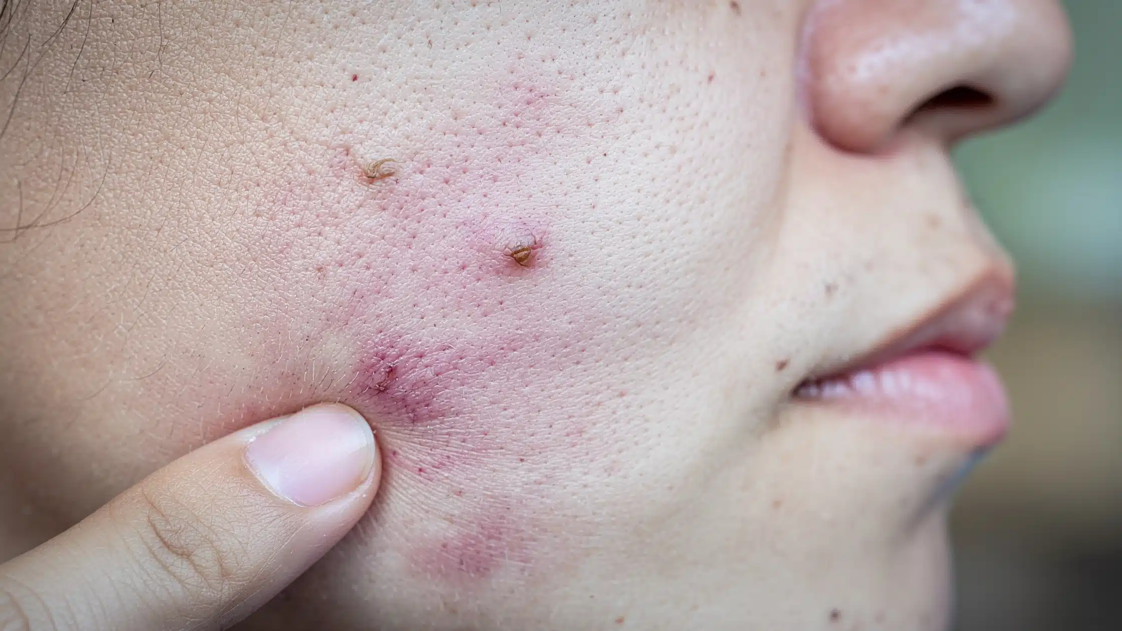 Common types of pimples on face — whiteheads, blackheads, papules, pustules, nodules and cystic acne